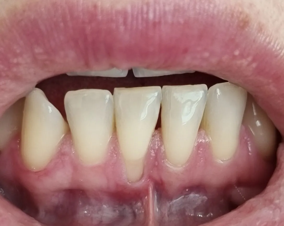 Gingivalna recesija na donjim prednjim zubima